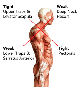 Upper Crossed Syndrome