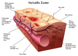 Painkilling relief for shingles