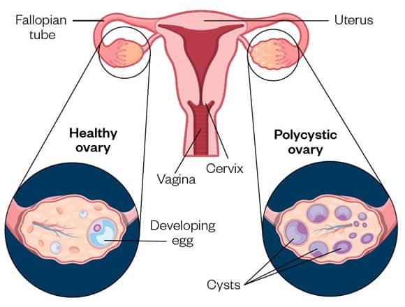 Polycystic ovary syndrome