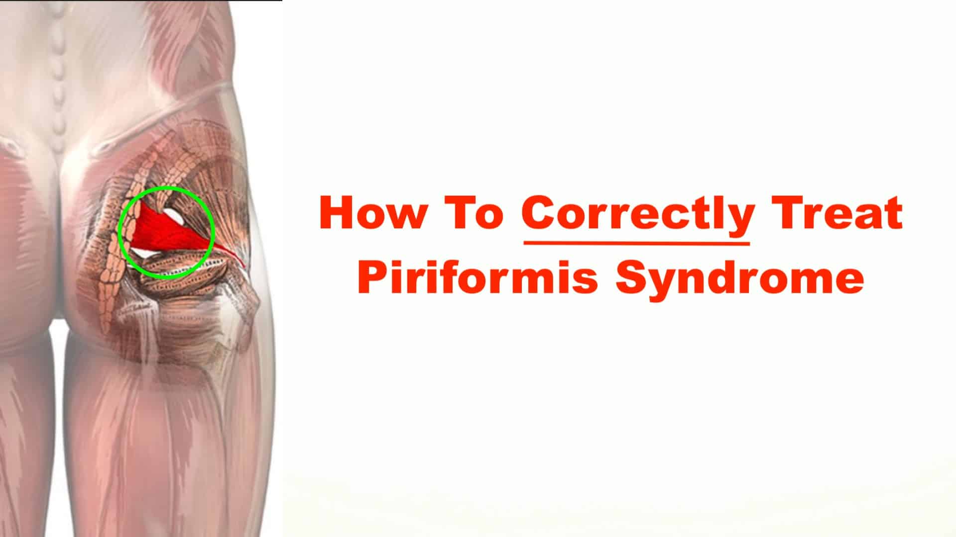 Piriformis Syndrome with Acupuncture Treatment