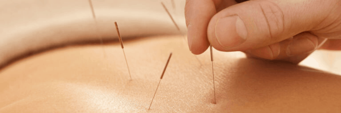 back acupuncture