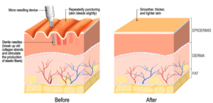 collagen rejuvenation