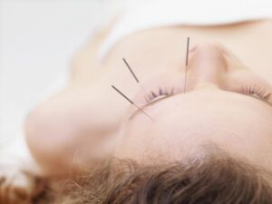 facial acupuncture