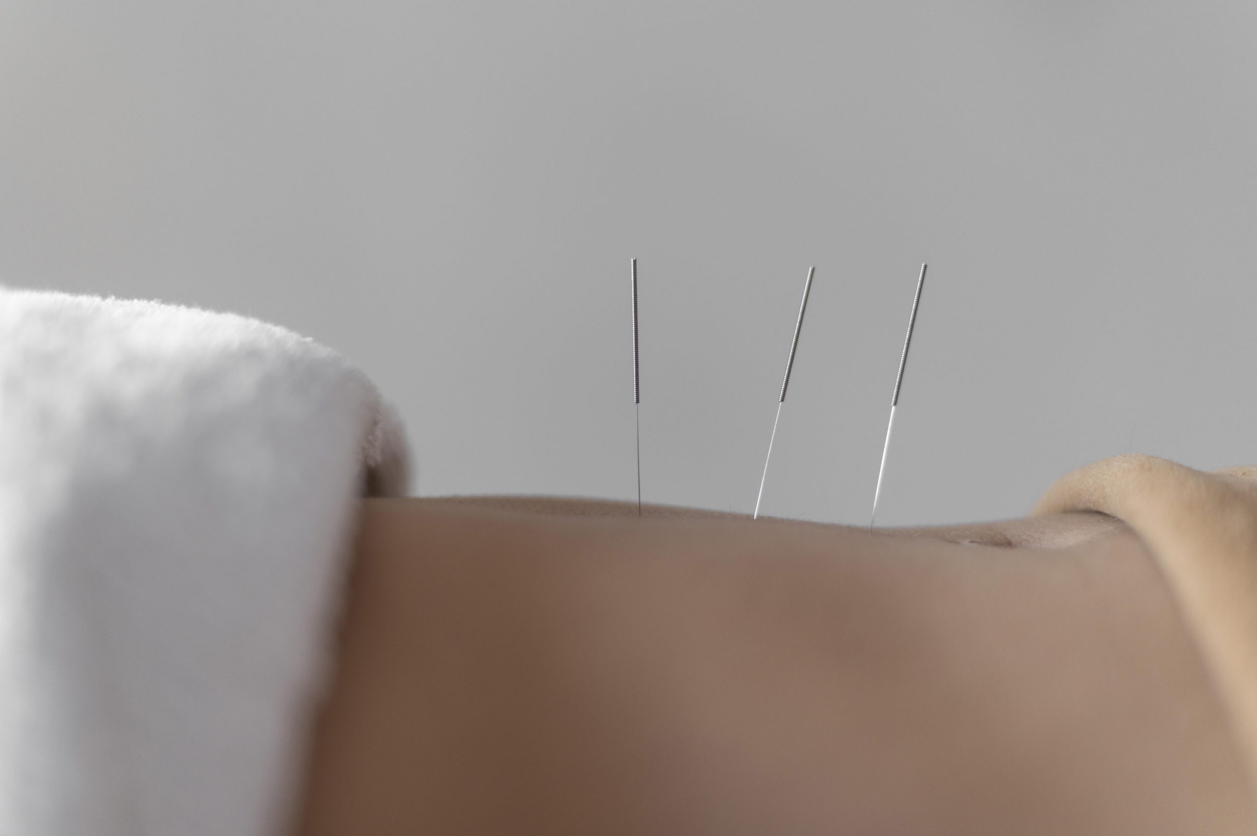 acupuncture