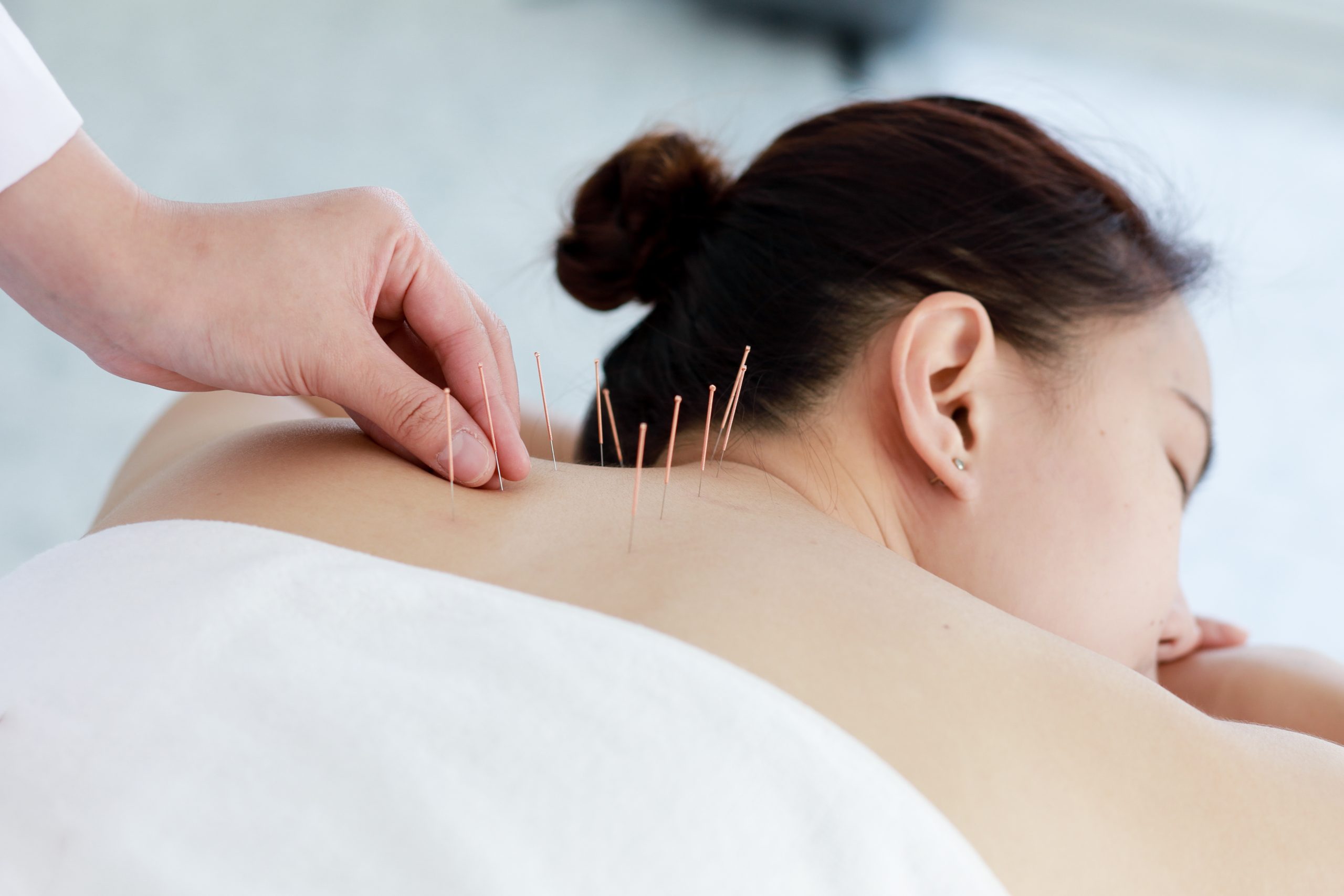 woman acupuncture
