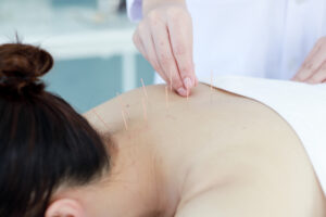 hand-doctor-performing-acupuncture-therapy-asian-female-undergoing-acupuncture-treatment-with-line-fine-needles-inserted-into-her-body-skin-clinic-hospital