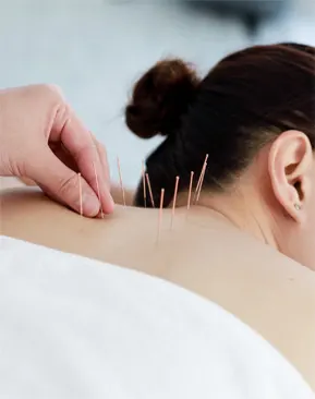 acupuncture treatment