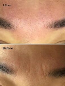 frown lines firming case1