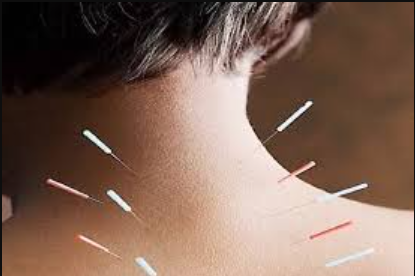 Acupuncture Treatment for Neck Pain