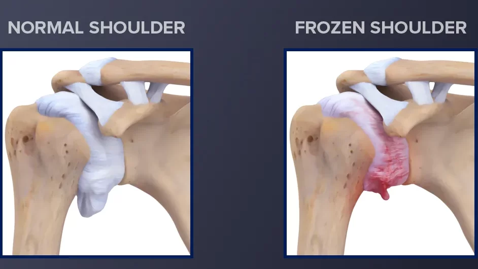 Frozen shoulder