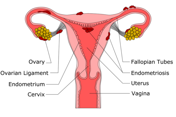 endometriosis