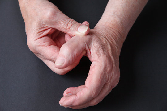 synovitis