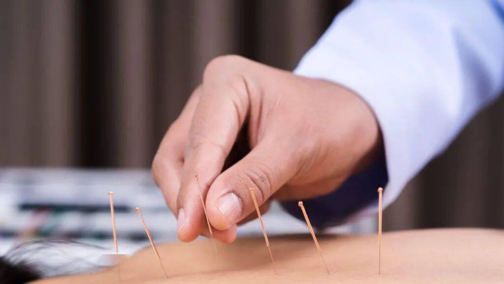 acupuncture for endometriosis