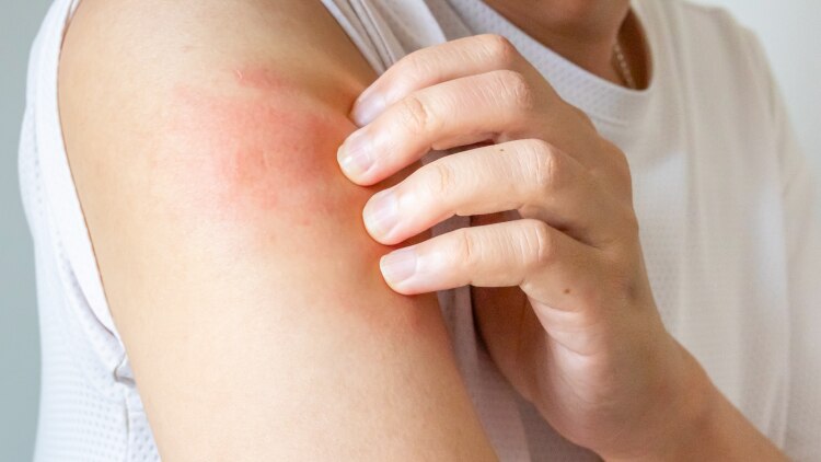 eczema treatment auckland