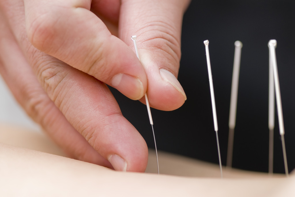 Acupuncture cosmetic acupuncture