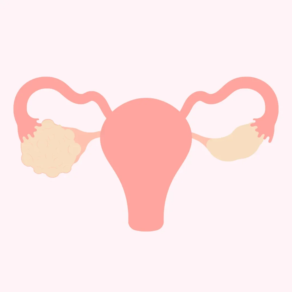 PCOS treatment PCOS treatment