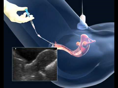 acupuncture for embryo transfer